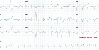 Syncope in a young man