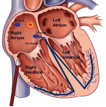 درمان تندی ضربان قلب با اَبلیشن (Ablation)